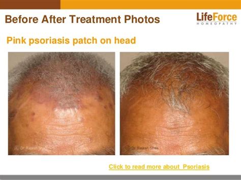 Psoriasis on Scalp & Head Photos: Before After Treatment Pictures