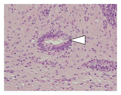 Pathological Findings In The Partially Resected Right Ovary A Gross