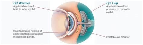 Lipiflow Treatment For Dry Eye Sightmd