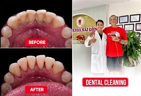 Understanding And Managing Black Tartar On Teeth - Saigon Center Dental ...