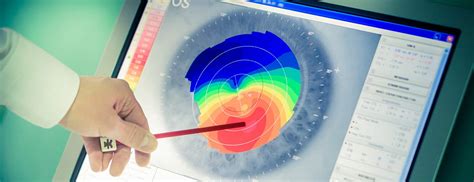 Intacs Keratoconus