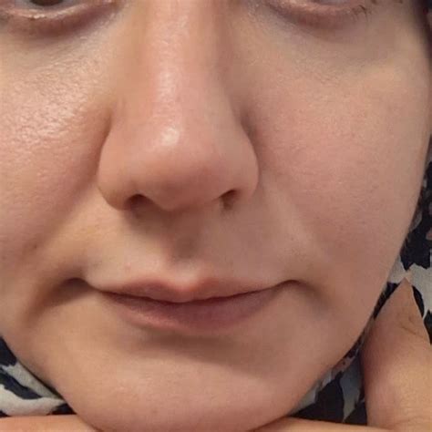 Kaş Tıp Merkezi Hemoroid Anal Fisür Ameliyatı Şikayetvar