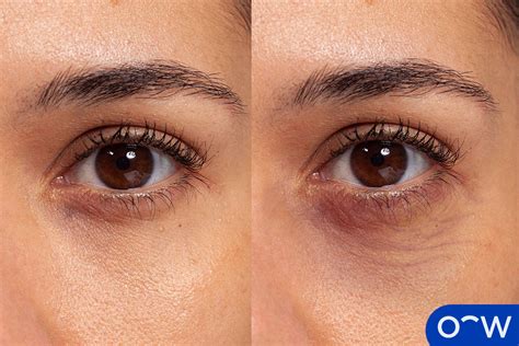 Puffy Eyes Definition Causes Symptoms And Treatment