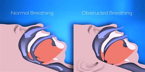 Researchers Examined The Link Between Obstructive Sleep Apnea Syndrome