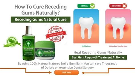 How To Cure Receding Gums Naturally