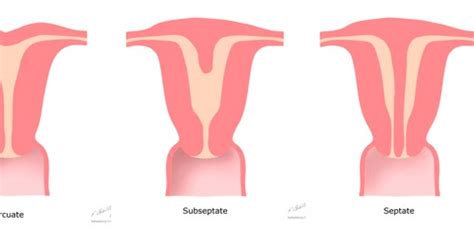 Kristen's Blog: 1. Uterine Anomalies for Reference