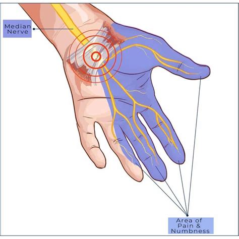 Carpal Tunnel Symptoms Treatment Spine Orthopedic Center