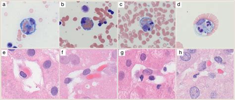 Pathology Updates And Diagnostic Approaches To Hemophagocytic Lymphohistiocytosis Diagnostic