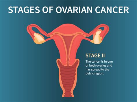 Stage 4 Ovarian Cancer: Meaning, Treatment & Survival Rates | Sage ...