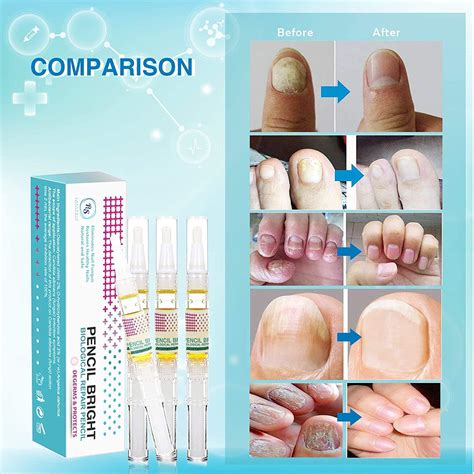 Extra Strength Nail Fungus Treatment - Effective Toe and Fingernail