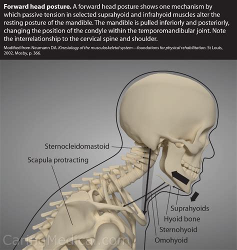 Forward Head Posture Symptoms And Complications