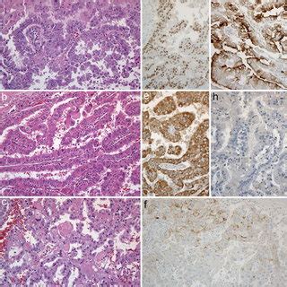 Tumor Histology And Immunohistochemistry A Carcinoma From The Left