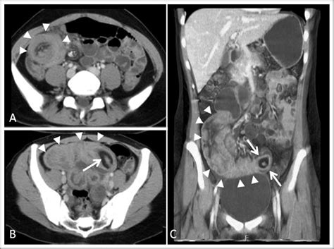 Ileoileal Intussusception Due To Ileal Ectopic Pancreas With Abundant