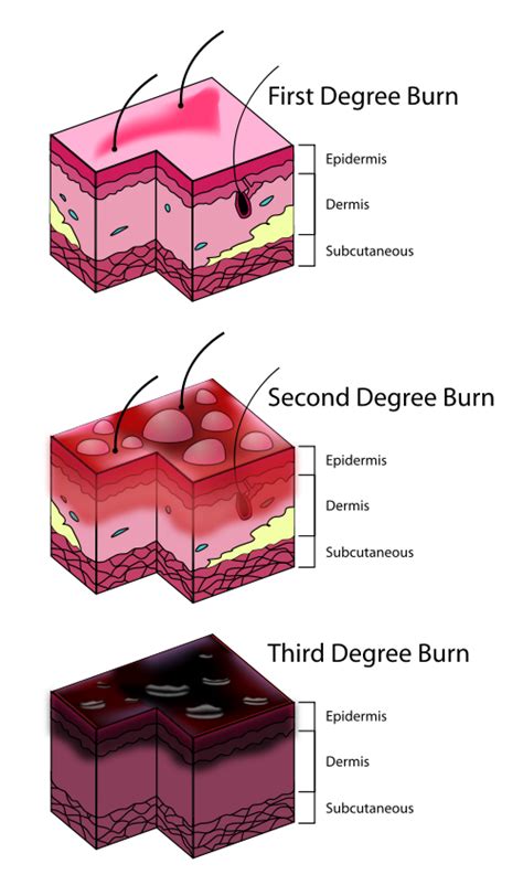 First Degree Burn Second Degree Burn Third Degree Burn Injury New Jersey Burn Injury Lawyer