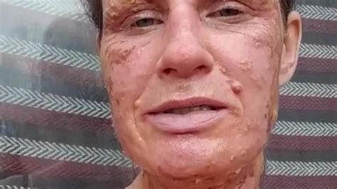 Horror As Mother Suffers Third Degree Burns All Over Her Face Chest