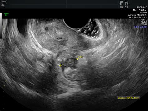 role  endometriosis specialists doctors  treatment