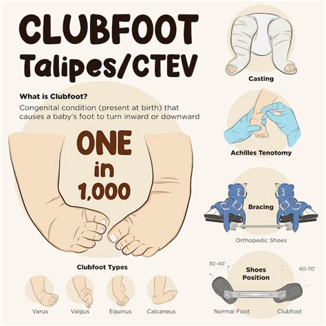 Premium Vector | Line vector of clubfoot infographic. treatment for ...