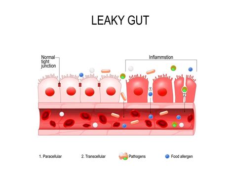 The Paleo Nurse Presents: Leaky Gut: What Is It and What Causes It ...