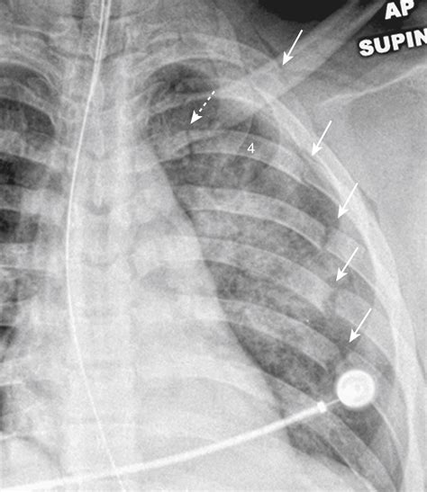 Recognizing The Imaging Findings Of Trauma To The Chest Clinical Tree