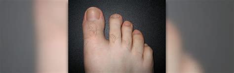 Discolored Toenails Facts General Center