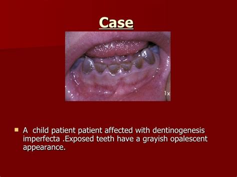 Dentinogenesis Imperfecta