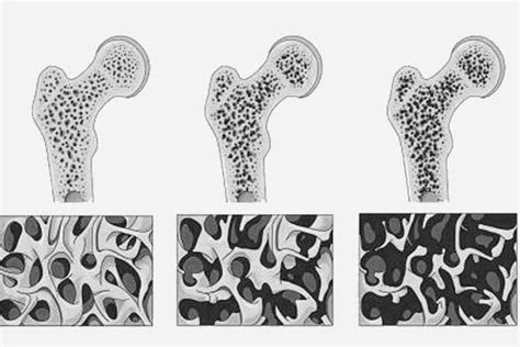 ¿qué Es La Osteoporosis Prevención Y Tratamiento Eq Bilbao