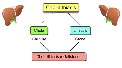 Made Easy Cholelithiasis Vs Cholecystitis Vs Choledocholithiasis Vs