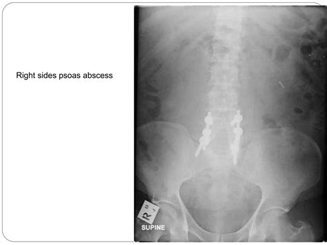 abdominal x ray radiology | PPT