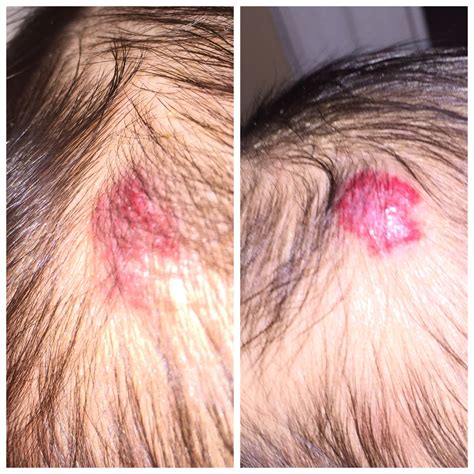 Cherry Hemangioma Scalp