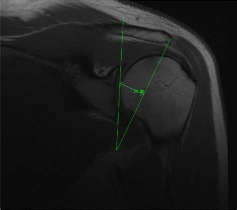 The Critical Shoulder Angle Represented By The Line Connecting The