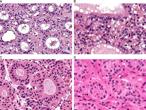 recurrent idh mutations  salivary gland striated duct adenoma define