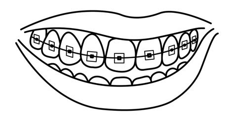 Amazing How To Draw Braces Check It Out Now Howtopencil1