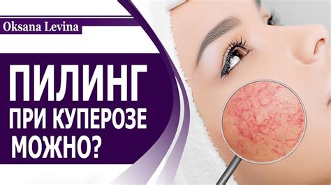 Пилинг при куперозе: какой можно делать в домашних условиях