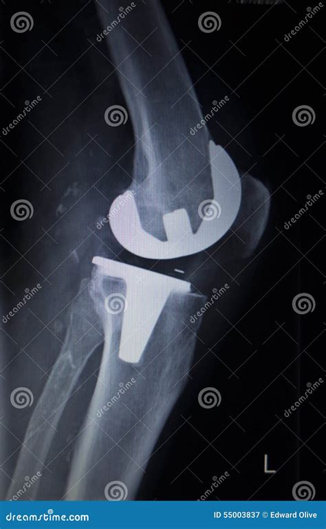 X Ray Orthopedics Scan Of Knee Meniscus Implant Prosthetics Stock Image