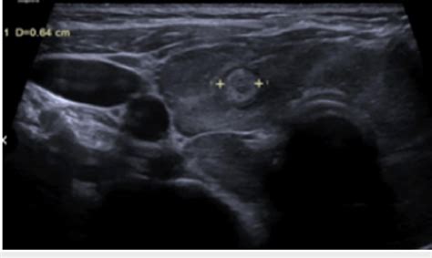 Ultrasound of thyroid. Heterogeneous thyroid echogenicity with ...