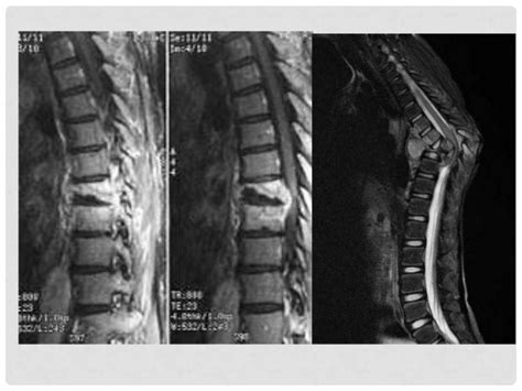 Mal De Pott Dr Esteban Castro Ortopedia Y Traumatolog A