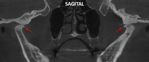 Osteoartrosis de ATM Dento Metric Radiología Dental Oral y