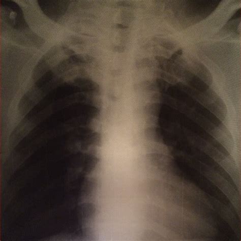 Tuberculosis On X Ray