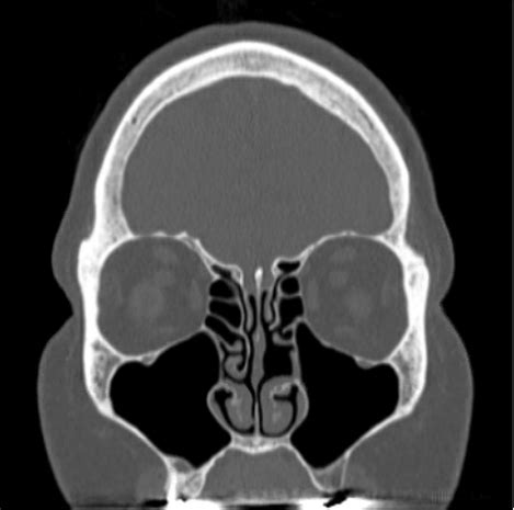 Advanced sinus surgery relieves nasal polyp symptoms – without a long ...