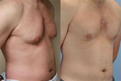 Breast Augmentation Gynecomastia Gallery Dr Paul Vanek Md