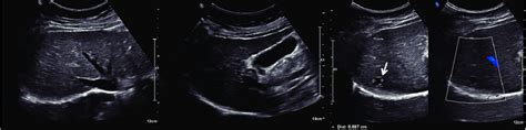 Abdominal Ultrasonography On Liver Definite Cirrhotic Nodules