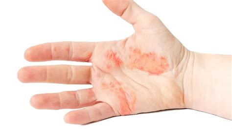 Hand Eczema (Hand Dermatitis) Treatment