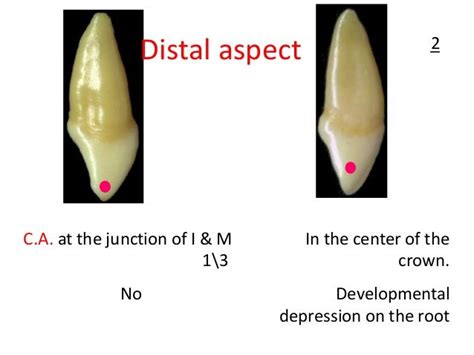 Upper Lateral Incisor