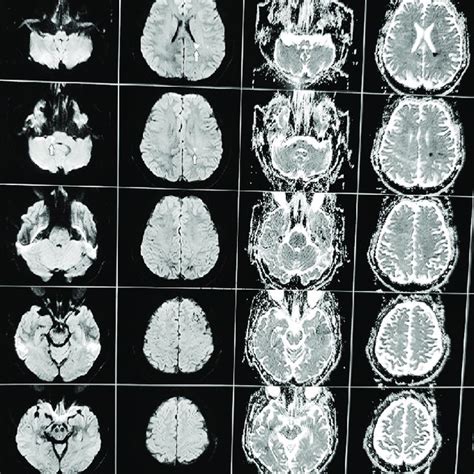 Mri Reveals Small Focus Area Of Restricted Diffusion With Corresponding