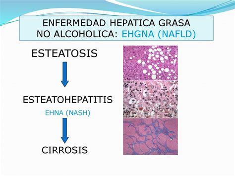 Enfermedad HepÁtica Grasa No AlcohÓlica Ppt Descargar