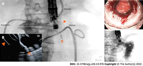 Endoscopic Ultrasound Guided Gastrojejunostomy A And B The Small