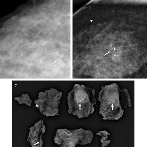 A 49 Year Old Woman With New Diagnosis Of Invasive Ductal Carcinoma And