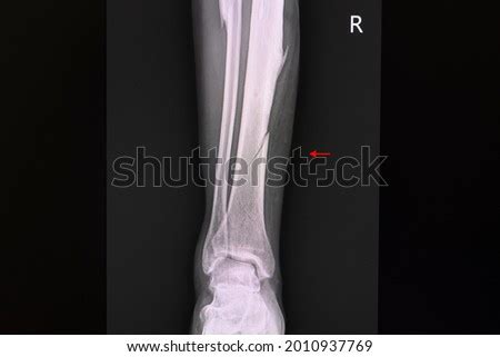 MIDSHAFT FRACTURE Stock Photos And Images Avopix