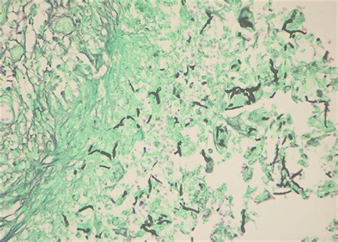 Gomori Methenamine Silver Stained Section Showing Black Staining Hyphae Download Scientific