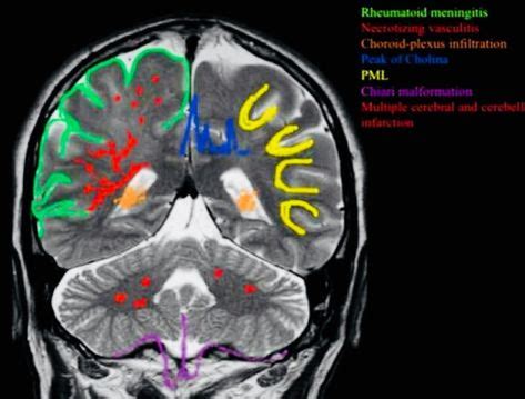 24 CNS RADIOLOGY ideas | radiology, cns, mri brain